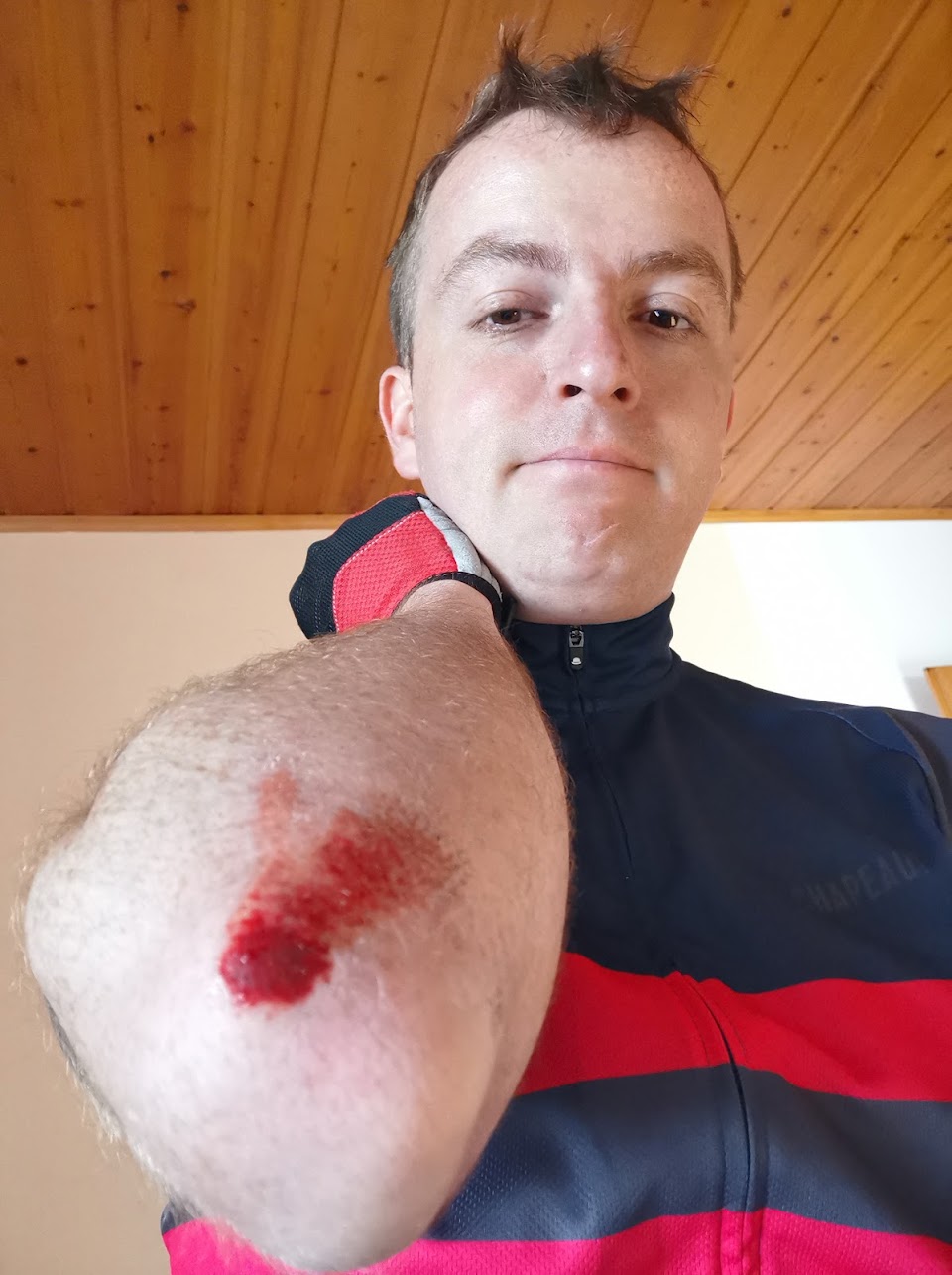 Elbow injury after trying to mount a badly designed entrance kerb